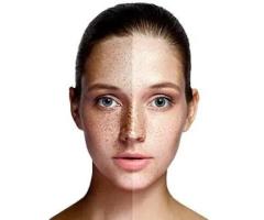 Skin Pigmentation Treatment