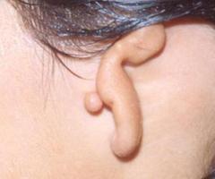 Ear Reshaping Surgery in USA