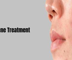 Acne Treatment in Bangalore