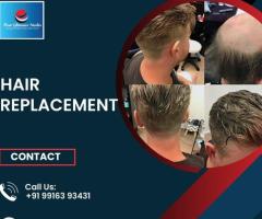 Hair Replacement in Bangalore | Hair Replacement center