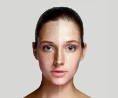 Pigmentation Treatment in Delhi